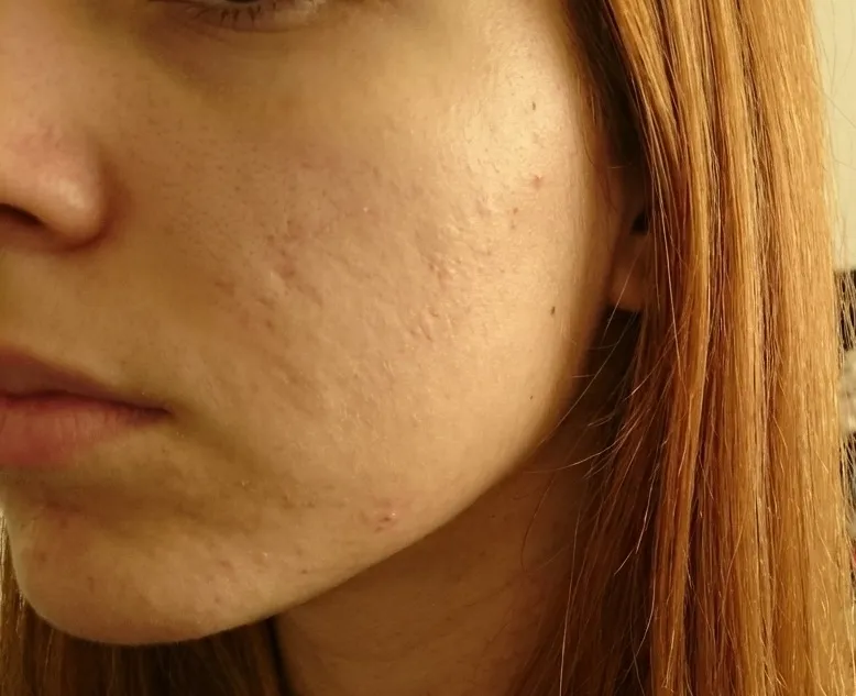 Letícia P. — antes