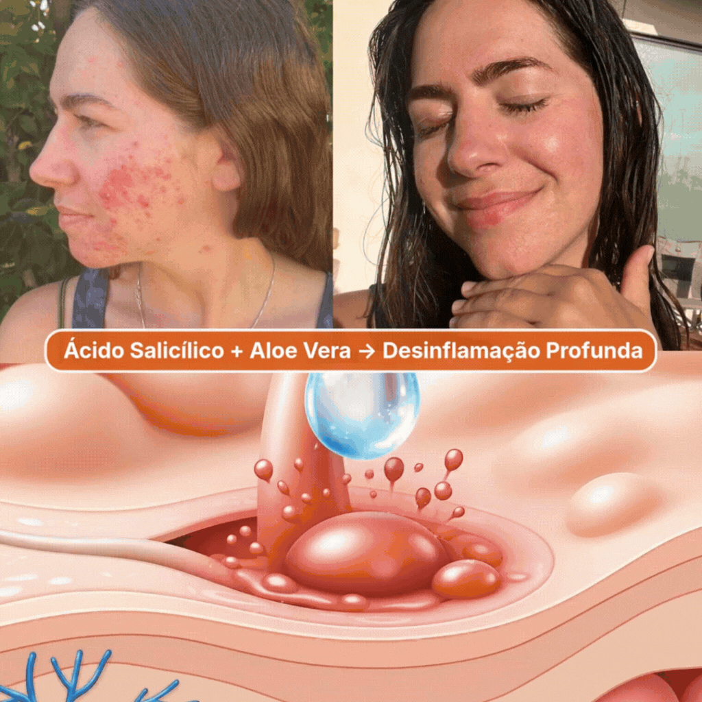 Sérum Antiacne Puraderme — mecanismo e provas